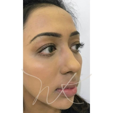 Trends in Non-Surgical Facial Contouring 